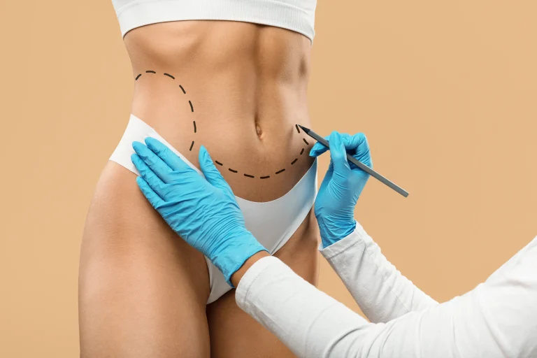 HD Liposuction
