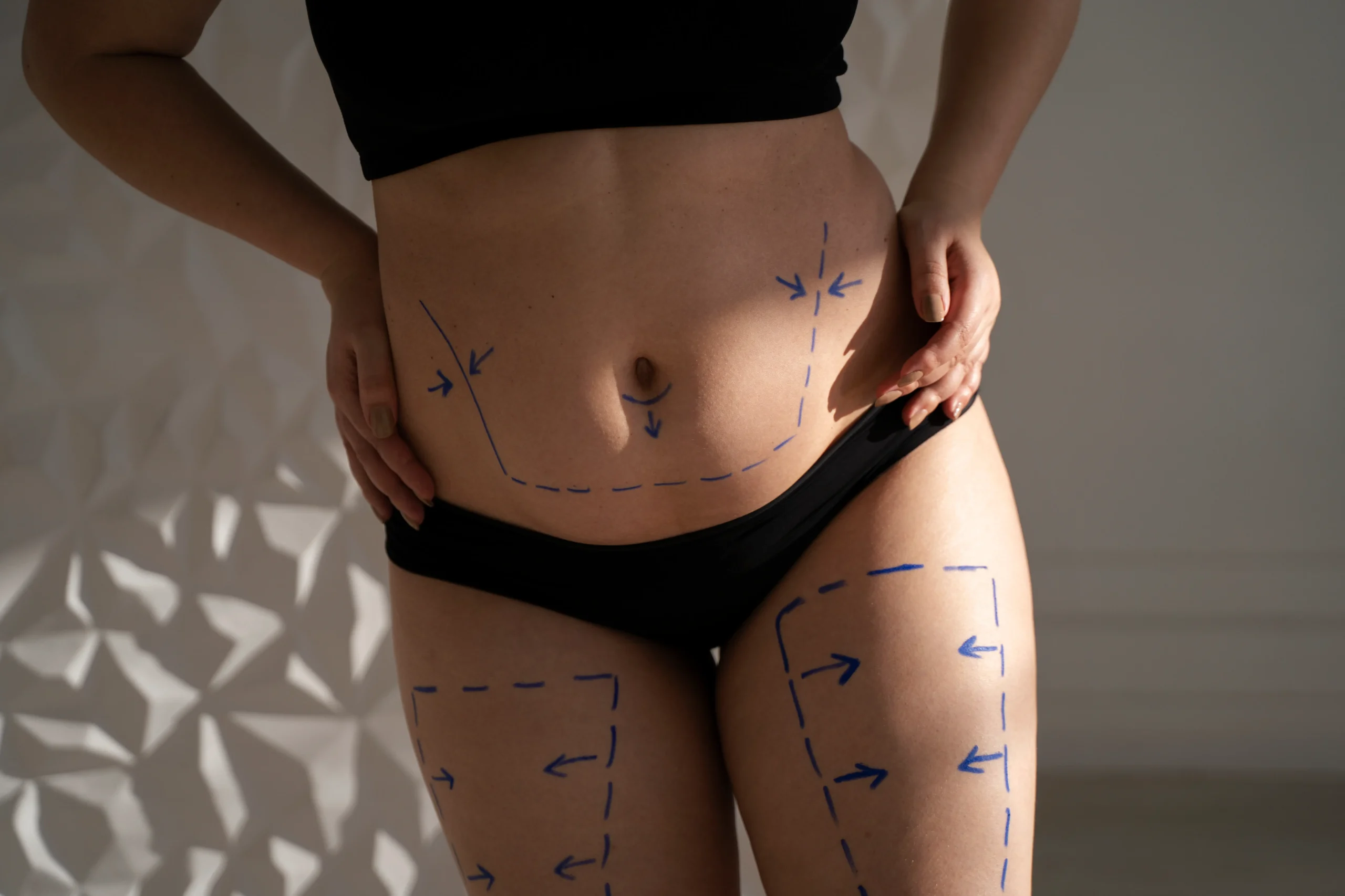 Lipoescultura HD