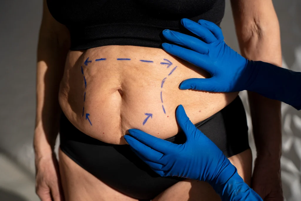 Abdominoplastia
