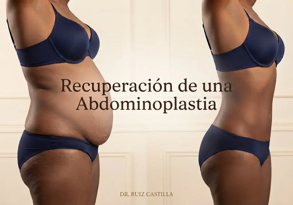 Recuperación de una Abdominoplastia