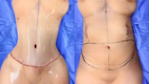 Contorno abdominal después de abdominoplastia