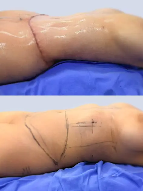 Marcación de abdominoplastia