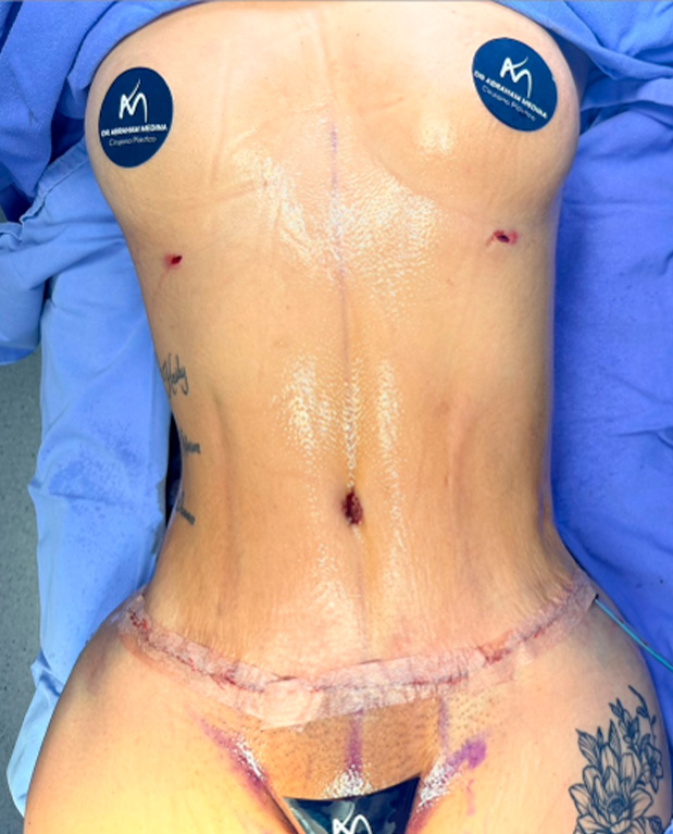 Después de abdominoplastia — caso 3