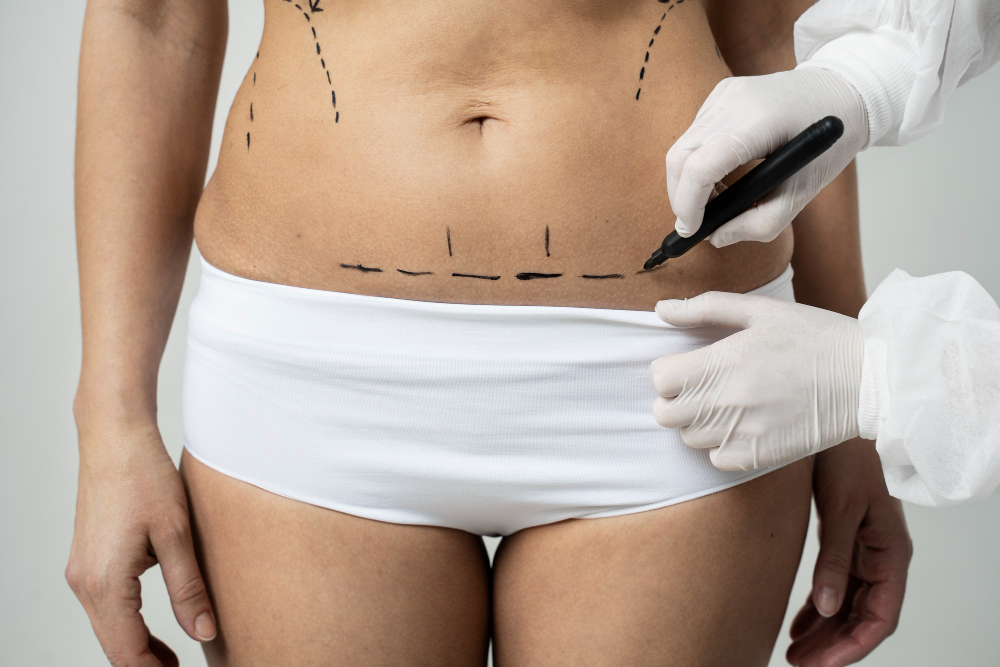 lipectomia abdominoplastia