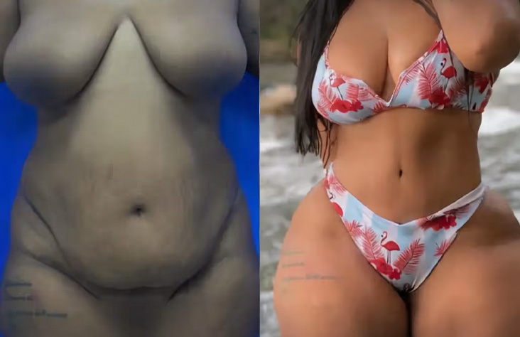 Antes y después abdominoplastia 1