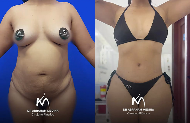 Antes y después abdominoplastia 2