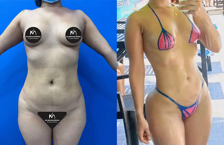 Antes y después lipoescultura 1