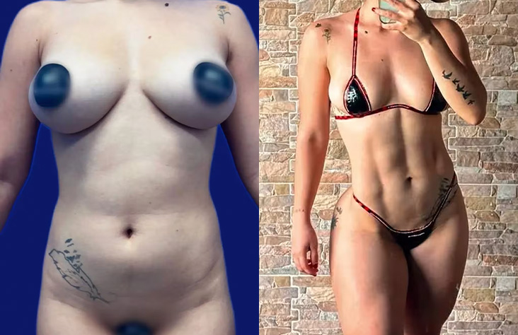 Antes y después lipoescultura 2