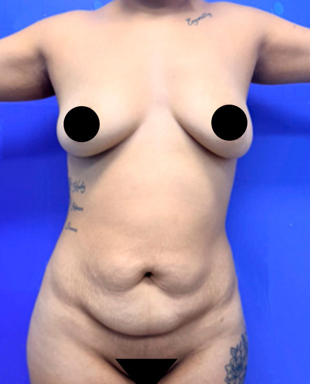 Antes de abdominoplastia — caso 3