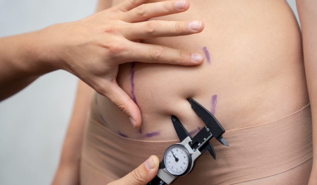 Lipectomia de abdomen