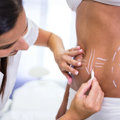 surgeon-drawing-lines-womans-abdomen-liposuction-cellulite-removal
